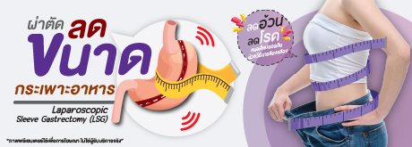 ผ่าตัดลดขนาดกระเพาะอาหาร