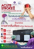 ACUTE STROKE ภาวะที่หลอดเลือดสมองตีบ แตก ตัน ทำให้ 
