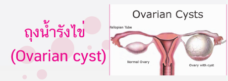 ถุงน้ำรังไข่ (Ovarian cyst)
